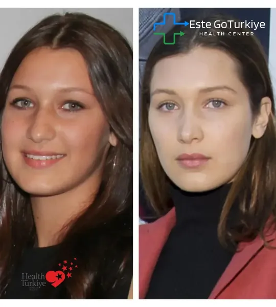 1. Rinoplastia – O “Nose Job” de Muitas Estrelas - Bella Hadid