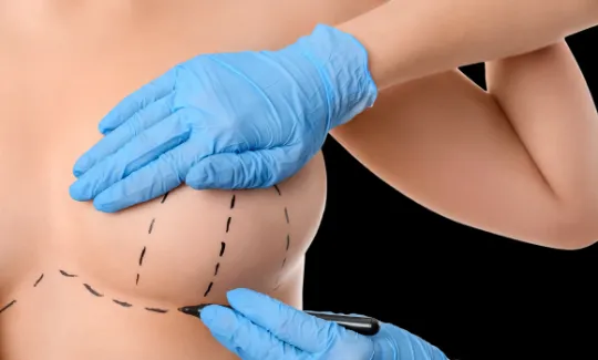 Mastopexia: elevação e simetria das mamas com cicatrizes estratégicas — foto ilustrativa.