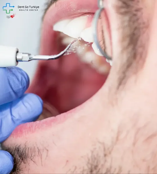 A Importância da Limpeza do Tártaro para um Sorriso Saudável