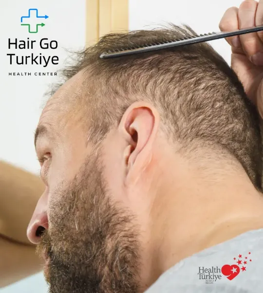 Principais Causas da Queda de Cabelo em Homens