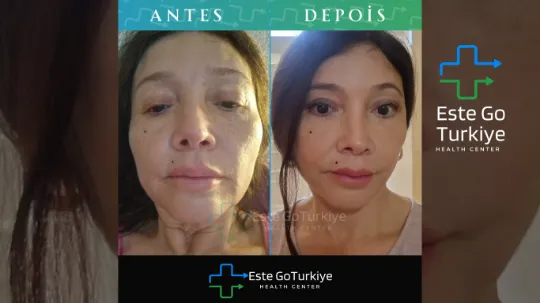 Paciente madura com rosto rejuvenescido após lifting facial.