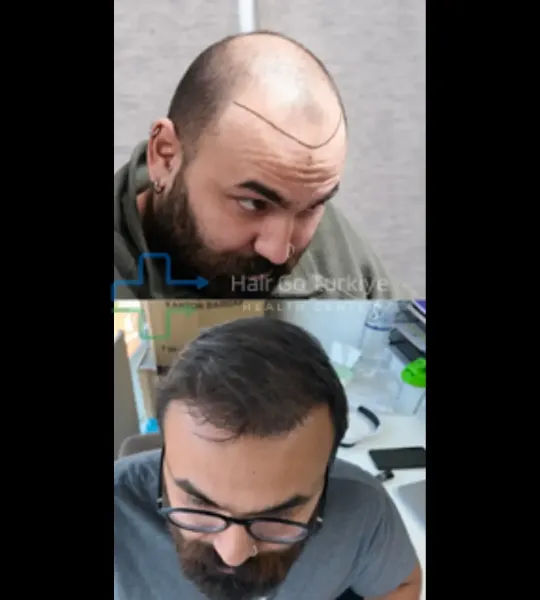 Transplante capilar FUE: antes e depois
