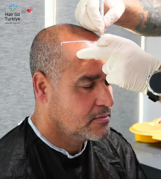 A área doadora é a região da cabeça onde os folículos capilares são retirados para o transplante. Esses fios são escolhidos por serem mais fortes e resistentes à ação do hormônio DHT, responsável pela queda de cabelo.