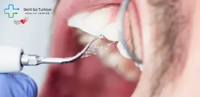 A Importância da Limpeza do Tártaro para um Sorriso Saudável