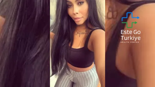 Resultado de abdominoplastia em mulher após gravidez, feita em clínica em Istambul.