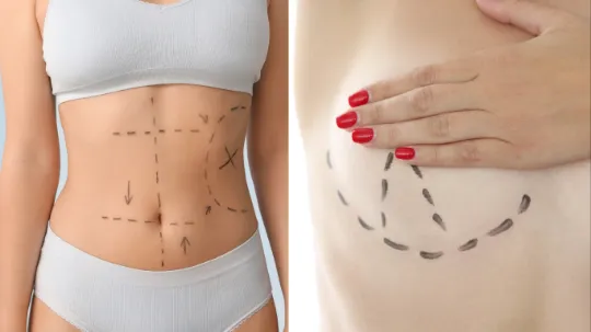 Mommy Makeover: combinação de abdominoplastia, cirurgia de mama e lipo para contorno harmônico — imagem ilustrativa.