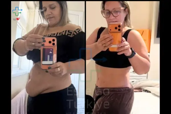 OP. DR. KAĞAN - CIRURGIA PLÁSTICA -Antes depois