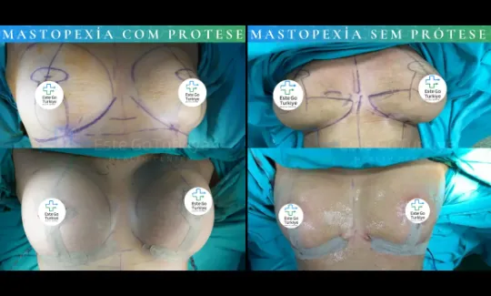 Mastopexia com ou sem prótese? Guia de decisão