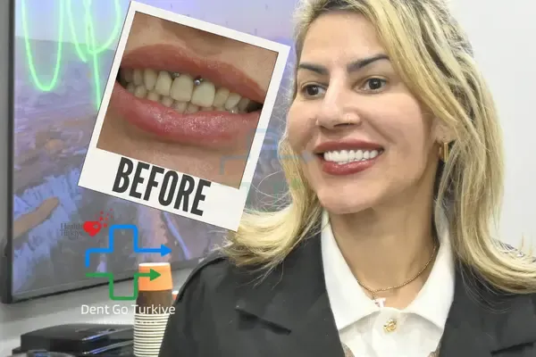 Antes e depois do tratamento dentário