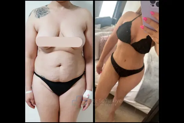 OP. DR. TULGA - CIRURGIA PLÁSTICA -Antes depois