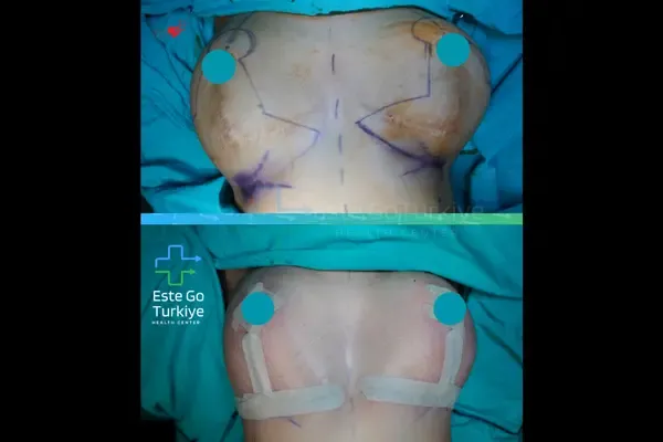 OP. DR. KAĞAN - CIRURGIA PLÁSTICA -Antes depois