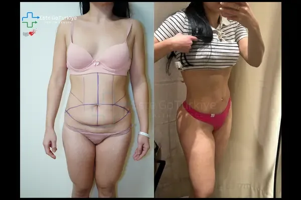 OP. DR. MEMET - CIRURGIA PLÁSTICA -Antes depois