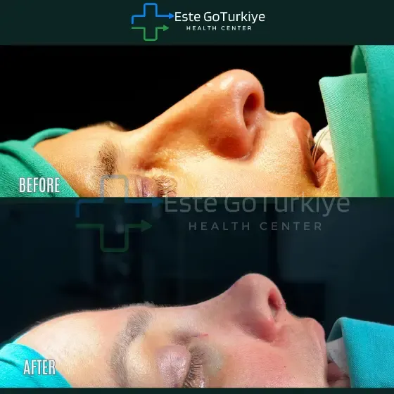 Antes e depois da rinoplastia na Turquia