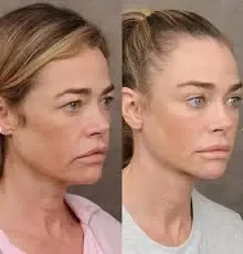 4. Facelift e Rejuvenescimento Facial - Denise Richards