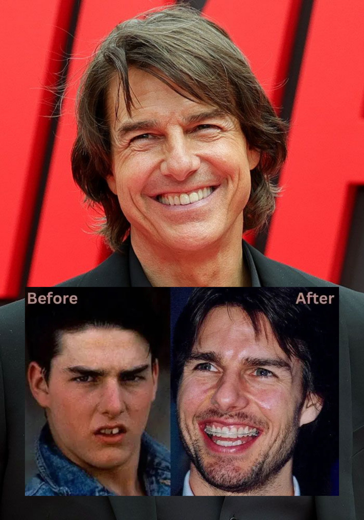 Evolução do sorriso de Tom Cruise após procedimentos de ortodontia e estética dental.