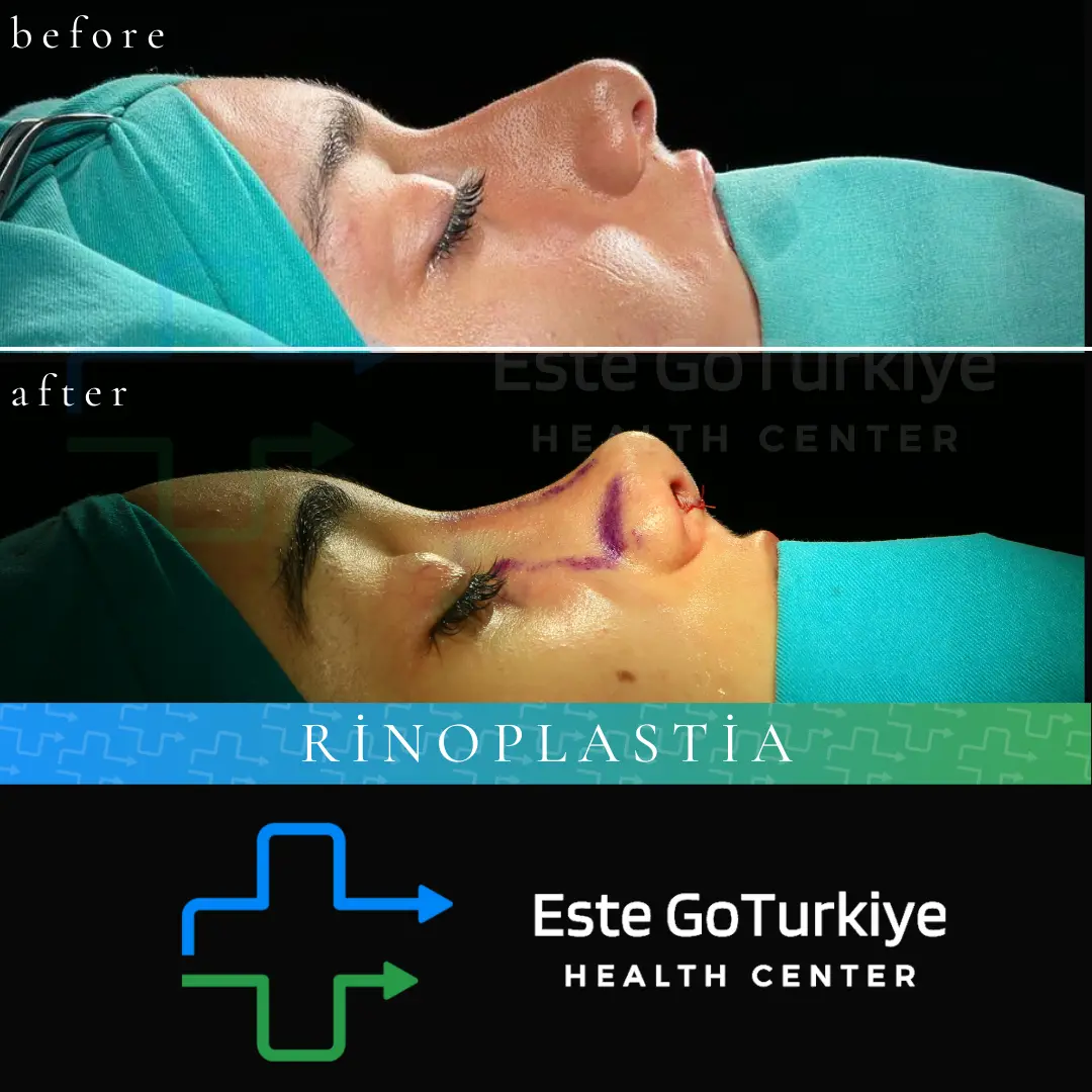Um nariz harmonioso e natural para realçar sua beleza!Com a rinoplastia, melhoramos a estética e a função respiratória, criando um perfil facial equilibrado e elegante.