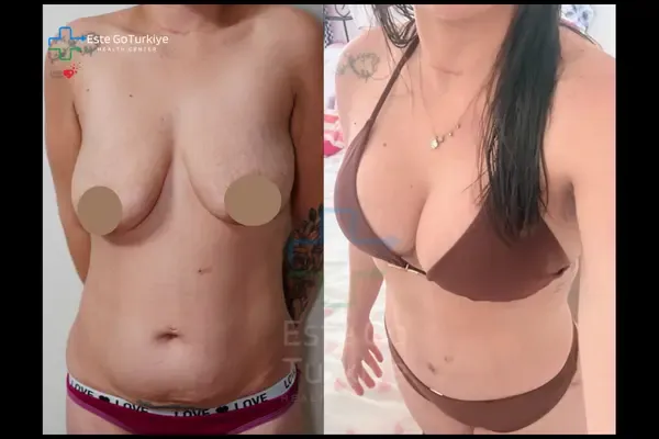 OP. DR. MEMET - CIRURGIA PLÁSTICA -Antes depois