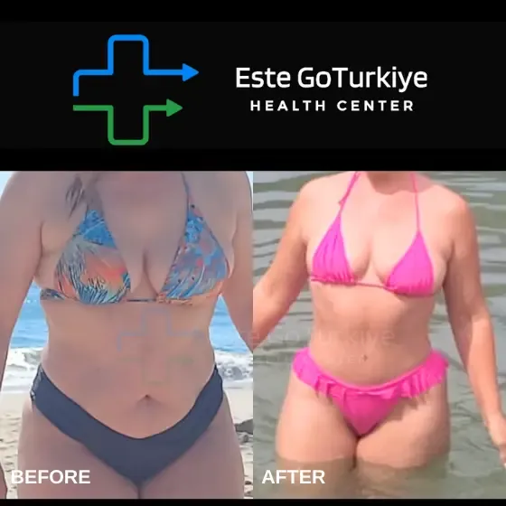 Antes e depois da abdominoplastia na Turquia