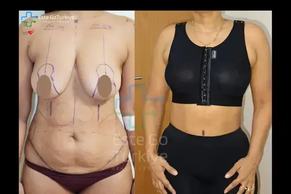 OP. DR. KAĞAN - CIRURGIA PLÁSTICA - Antes depois