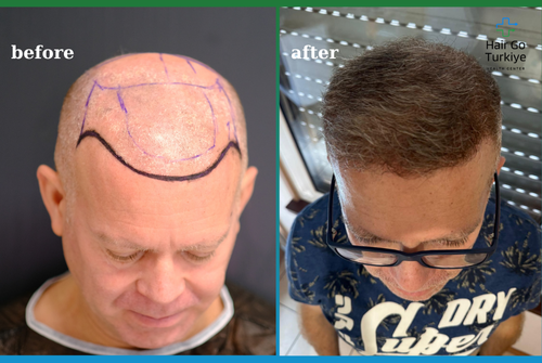 Antes e Depois do Transplante Capilar: A História de Transformação do Nosso Paciente