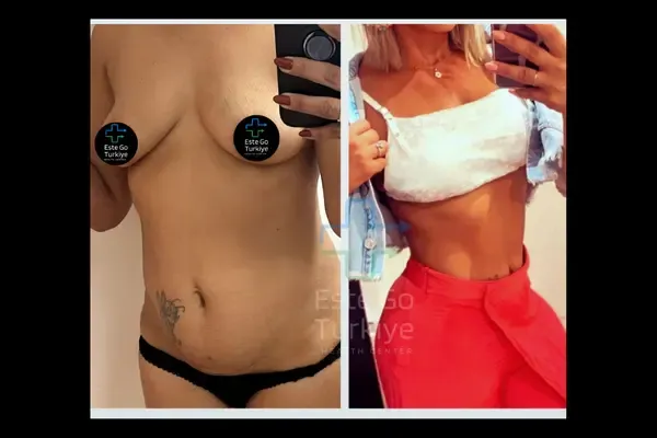 OP. DR. TOLGA - CIRURGIA PLÁSTICA -Antes depois