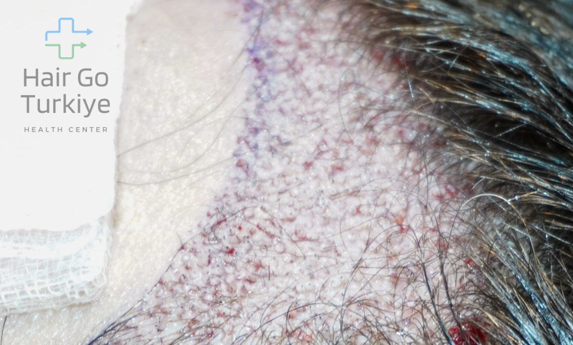 Transplante sem raspar (long hair): quando dá certo?