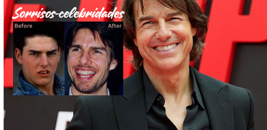 Celebridades com Sorrisos Icônicos: Estética ou Natural?