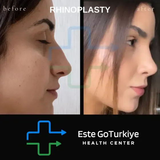 Antes e depois da rinoplastia na Turquia