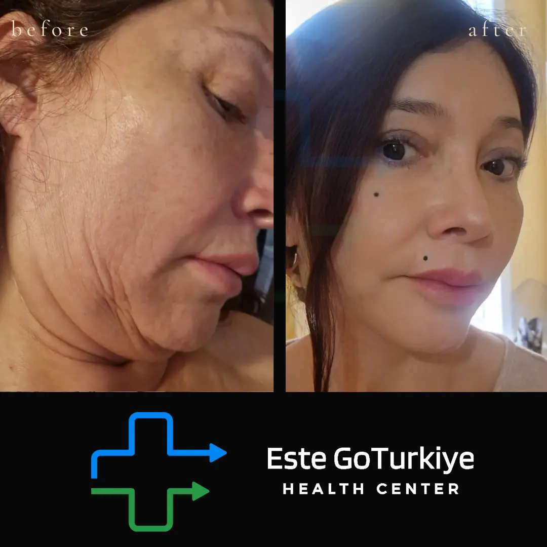 Antes e depois da cirurgia de lifting facial na Turquia
