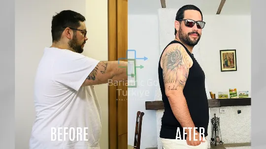 Antes e depois da cirurgia bariátrica