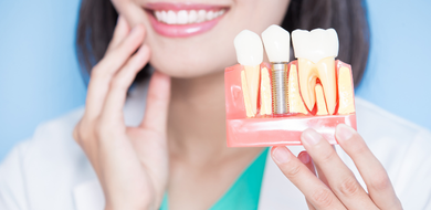 Implantes Dentários