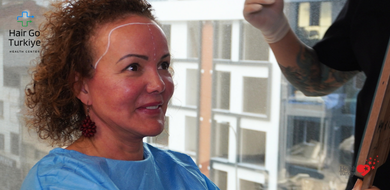 Por Que o Transplante Capilar Feminino é Seguro e Eficaz?