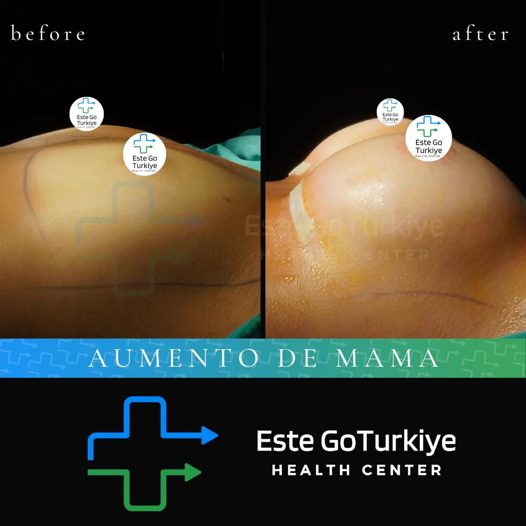 Seios mais volumosos, harmônicos e com aparência natural!O aumento de mama proporciona resultados que valorizam o contorno corporal e aumentam a autoestima.