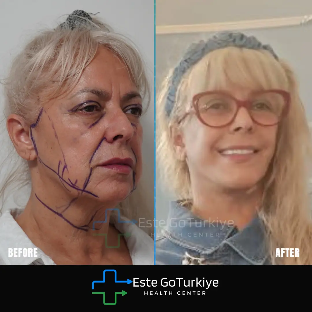 Antes e depois da cirurgia de lifting facial na Turquia