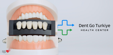 As Facetas Dentárias Parecem Naturais?