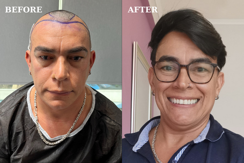 Jornada de Transplante Capilar: Transformações Incríveis