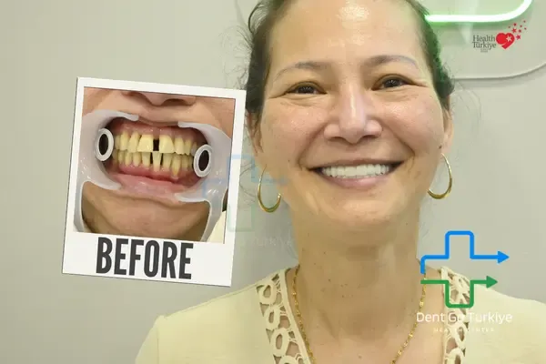 Antes e depois do tratamento dentário