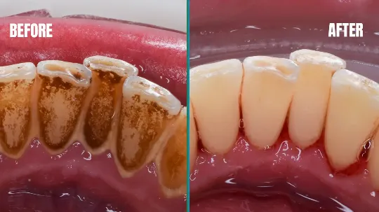 Dentista realizando limpeza de tártaro para manter a saúde bucal do paciente.