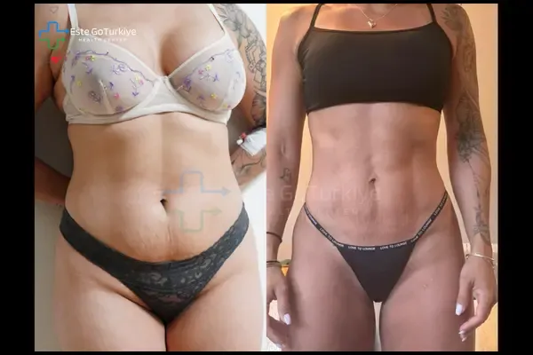 OP. DR. MEMET - CIRURGIA PLÁSTICA - Antes depois