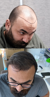 Depoimento real de paciente satisfeito com os resultados naturais do procedimento