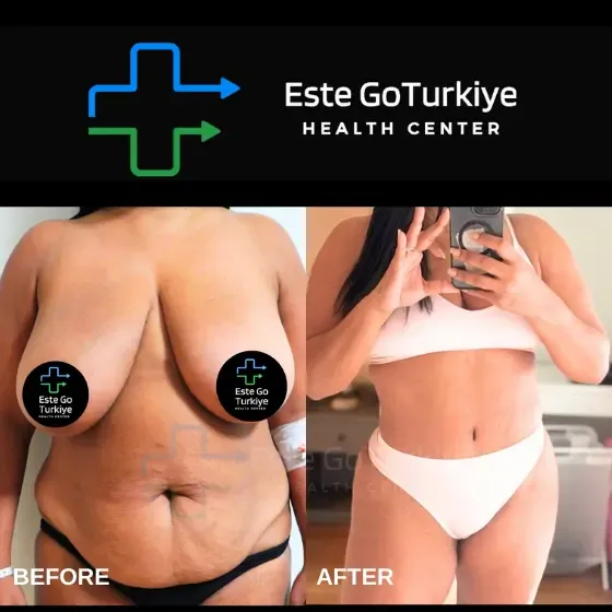 Antes e depois da abdominoplastia na Turquia