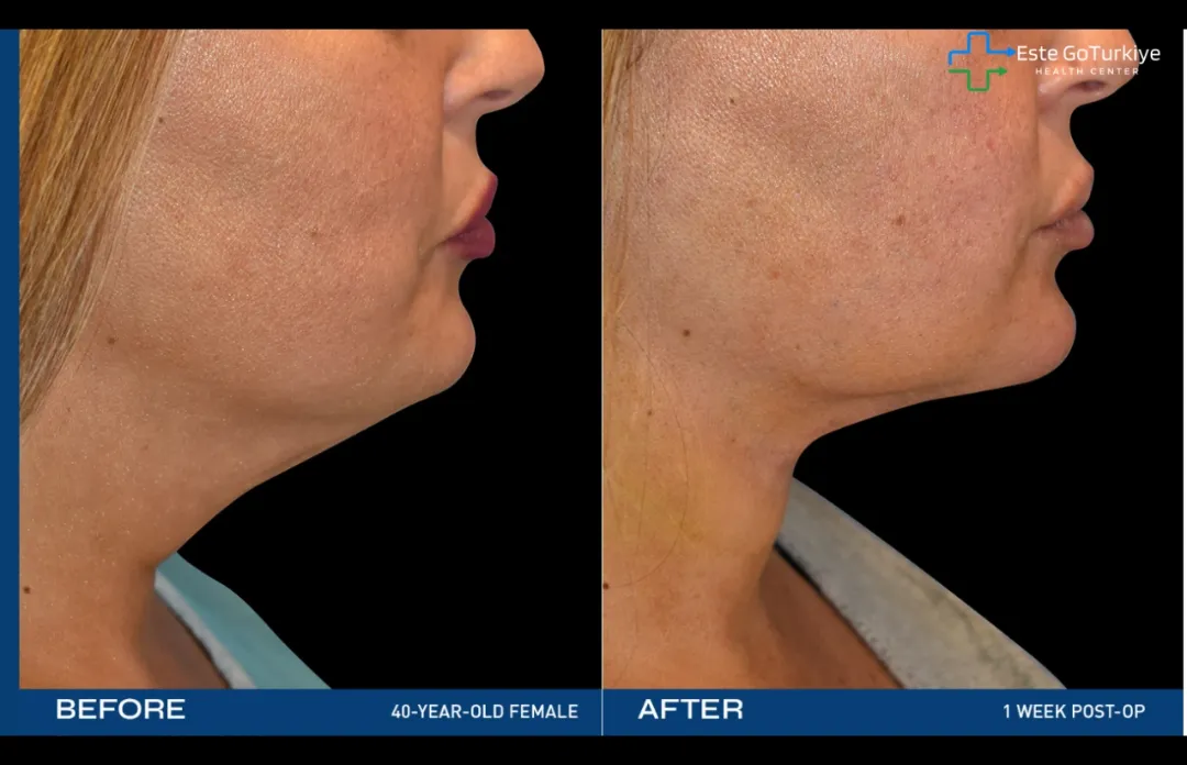 J-Plasma Renuvion: Reafirmação da Pele Segura e Eficaz