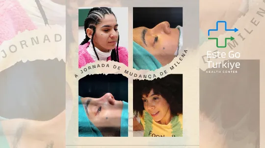 Resultado natural de rinoplastia em paciente mulher em clínica estética em Istambul.