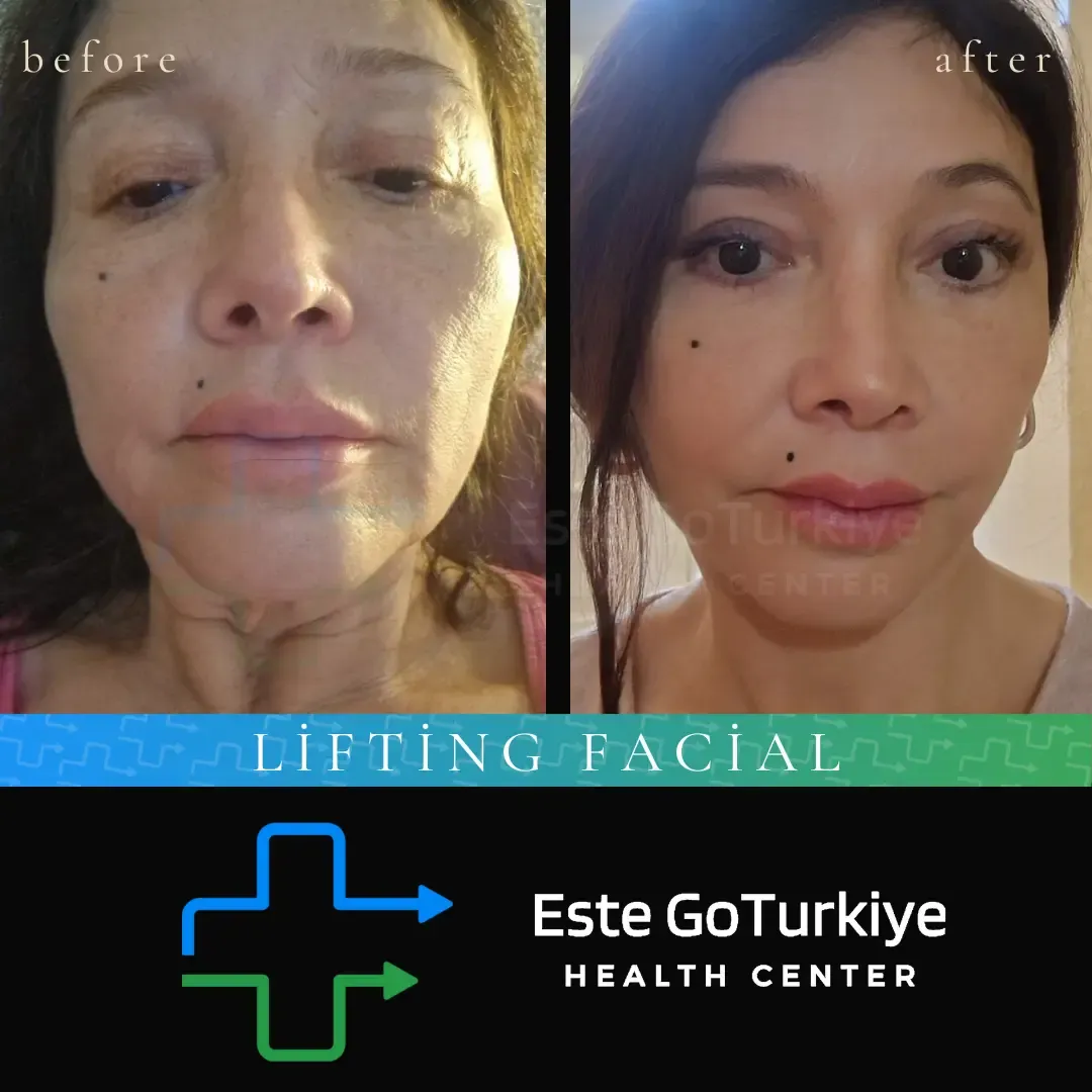 Desafie o tempo e redescubra sua juventude!O lifting facial elimina a flacidez e devolve firmeza e frescor ao rosto, com resultados naturais e duradouros.
