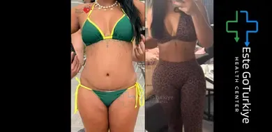Lipoaspiração Antes e Depois na Turquia: O Que Esperar dos Resultados