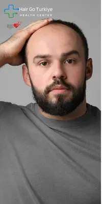 Calvície Masculina e Soluções com Transplante Capilar