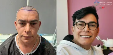 Transplante Capilar na Turquia:

FUE, DHI e Tratamentos para Queda de Cabelo