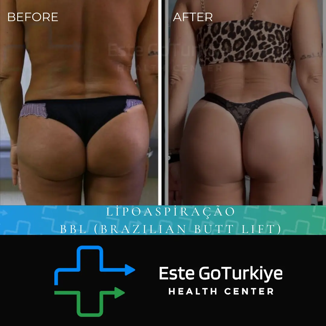 Elimine a gordura localizada e modele suas curvas com segurança! A combinação de lipoaspiração com BBL (Brazilian Butt Lift) utiliza a própria gordura do paciente para aumentar e definir os glúteos, criando um contorno corporal mais harmônico e atraente.