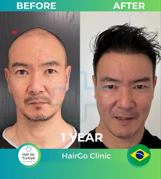 Transplante capilar DHI: antes e depois