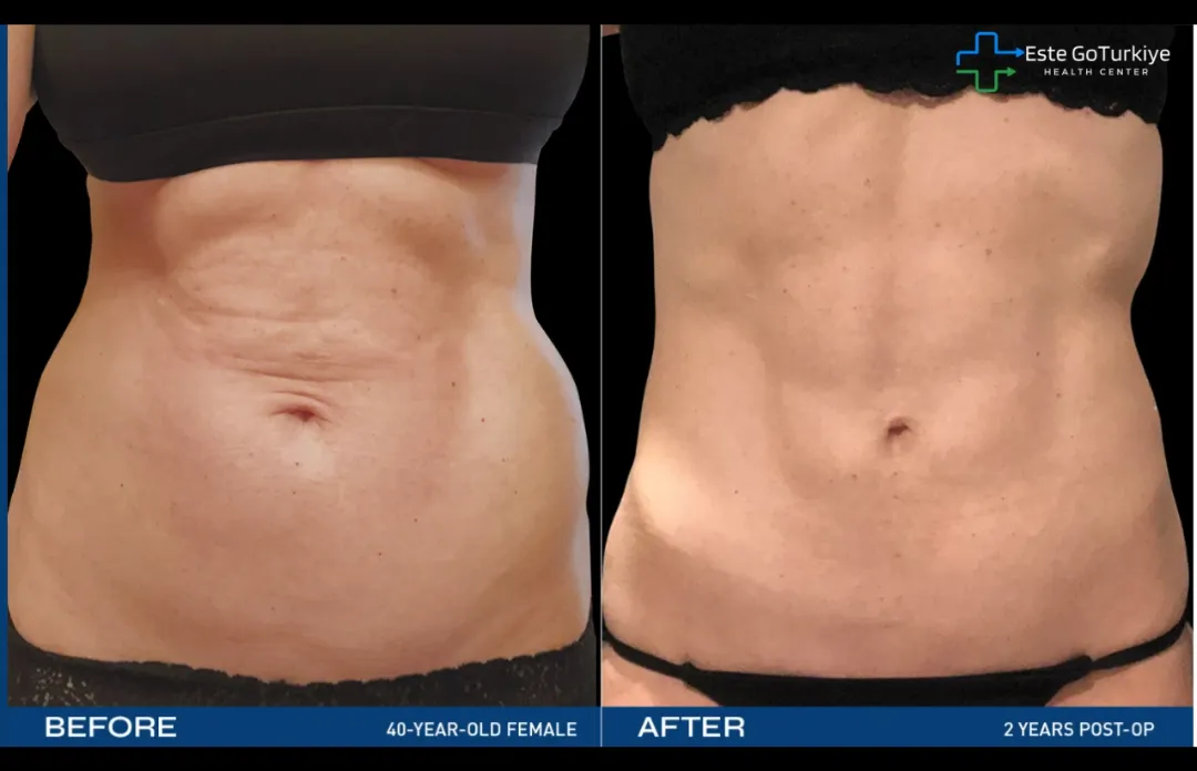 J-Plasma Renuvion: Reafirmação da Pele Segura e Eficaz